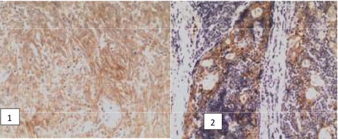 Gambar  1:  Timoma  tipe  A:  pewarnaan  imunohistokimiaPD-L1-positif,  membran  sel  tumor  menunjukkanpewarnaan linier dari kuning kecoklatan sampai coklat (metode Envision, × 200)