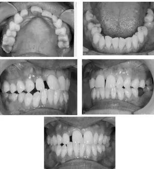 Gambar 2. gambar intra oral sebelum perawatan 