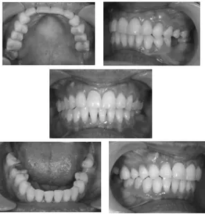 Gambar 4. Foto intra oral setelah debonding dan  