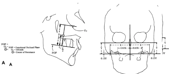 Gambar 5. Sistem gaya ekspansi sutura                    midpalatal pada bidang frontal