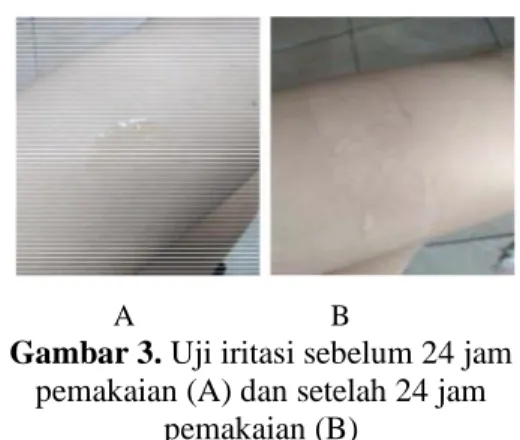 Gambar 3. Uji iritasi sebelum 24 jam  pemakaian (A) dan setelah 24 jam 