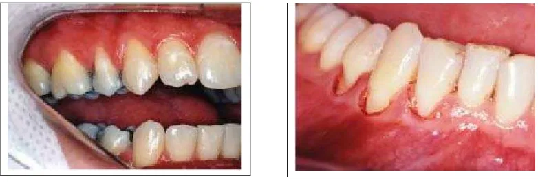 Gambar 1. Resesi multipel gingival klas I Miller pada (A) rahang atas dan  (B) rahang bawah