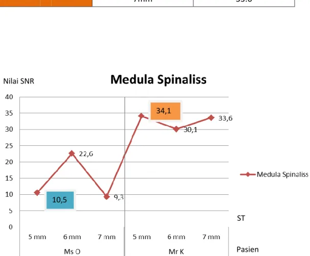 Gambar 4.5  Hubungan  nilai  ST  untuk  jaringan  Medula  Spinaliss  pada  nilai  SNR