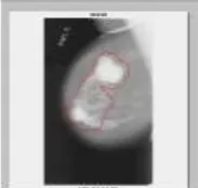 Gambar 3. Tampilan sistem IRMA untuk mencari citra mammografi 