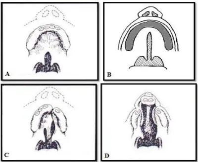 Gambar 1. A. Celah pada langit-langit lunak saja. B. Celah pada langit-langit lunak dan keras
