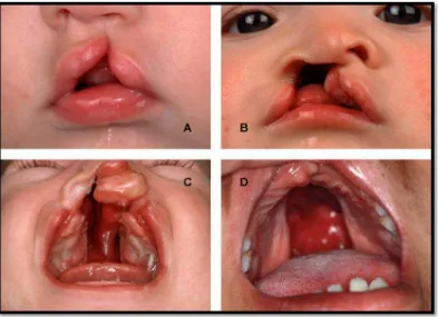 Gambar 2. (A) Celah bibir unilateral tidak komplit, (B) Celah bibir unilateral (C) Celah bibir bilateral dengan 