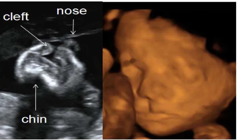 Gambar  7.  Penggunaan ultrasonografi sebagai cara untuk melihat terjadinya celah bibir pada masa kehamilan