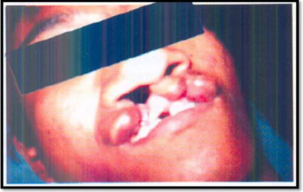 Gambar 10.  Foto pasien labiognatopalatoschizis bilateral komplit dan  tidak komplit. (I Ketut S & Prihartiningsih