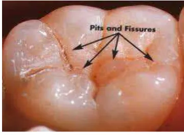 Gambar 2. Celah/fisure pada gigi yang       menjadi lokasi karies32 