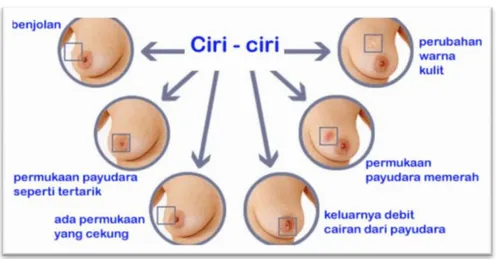 Gambar 2.2 Ciri - Ciri Penderita Kanker Payudara  (www.atmago.com)