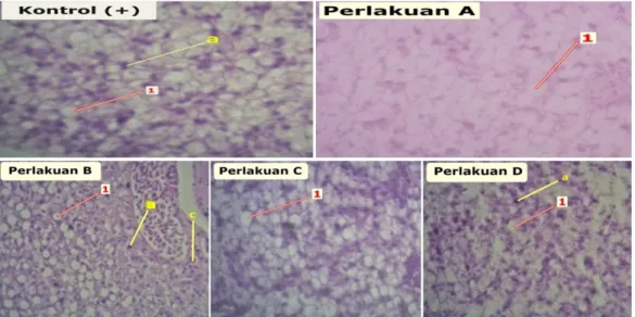 Gambar 4 Histopatologi hati kerapu tikus (Cromileptes altivelis) yang terinfeksi VNN dengan pewarnaan H-E dan perbesaran 400x
