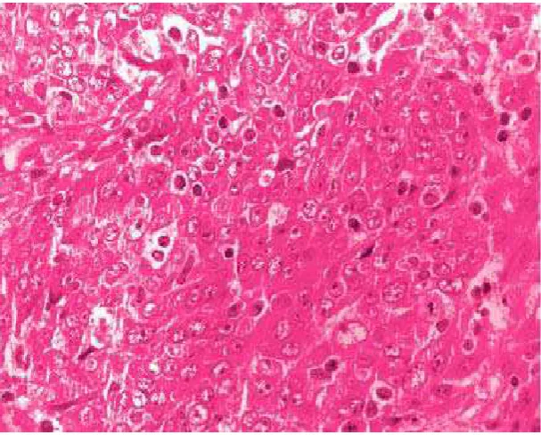 Gambar 2.6 Undifferentiated Carcinoma terdiri dari sel-selyang membentuk sarang-sarang padat( “Regaud type”)