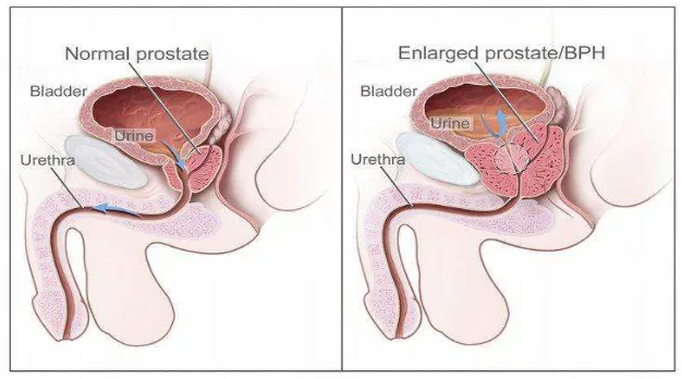 Gambar 2.1 : Gambaran normal prostat dan gambaran BPH Sumber: Wibowo, 2013, Referat Benign Prostat Hyperplasia 