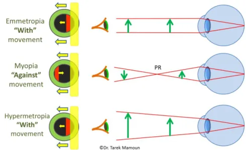 Gambar 4. Gerakan Refleks Retina Pada Pemeriksaan Retinoskopi Pada Mata  dengan Emetropia, Miopia dan Hipermetropia  
