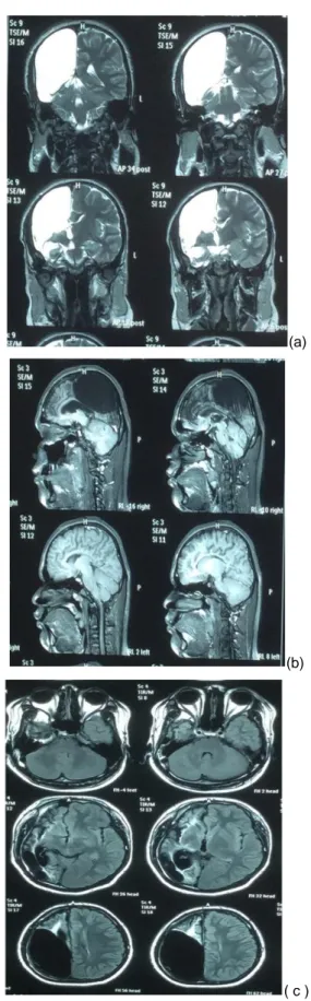 Gambar 1. brain MRI T1 (a) dan T2 (b) dan Flair (c).  
