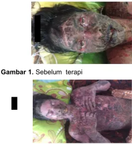 Gambar 1. Sebelum  terapi 