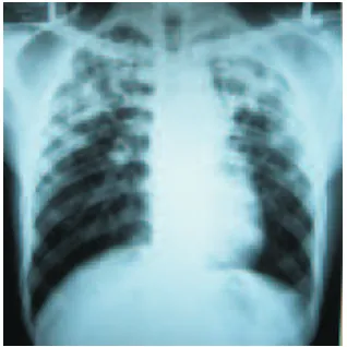 Gambar 2 Gambaran Foto Toraks Ibu Penderita: Tidak ditemukan TB 