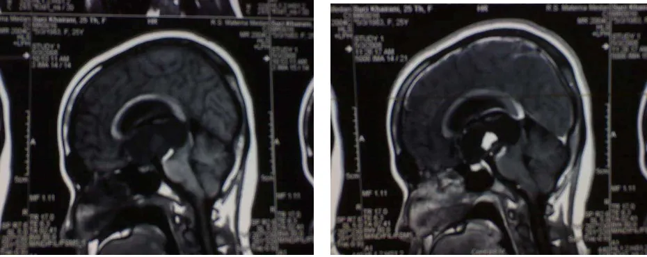 Gambar MRI potongan axial T1 weighted 