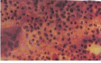 Gambar Sitologi ulkus disebabkan oleh mastitis kronik Kistik Payudara   