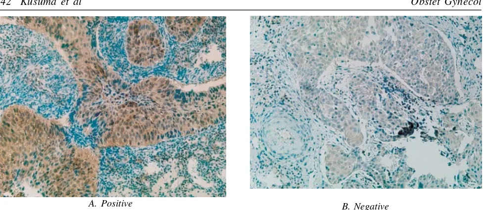 Figure 2. Cytoplasmic Survivin Expression in slide with immunohistochemical staining with 400x enlargement.A