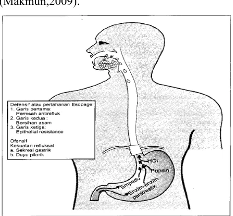 Gambar 2.2 Patogenesis terjadinya GERD (Makmun, 2009). 