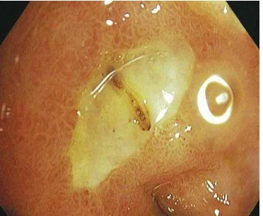 Gambar 2.1.  Gambaran endoskopi pada pasien gastric ulcer akibat penggunaan NSAIDs dan test H.Pylori negatif (Vakil, N., 2010) 