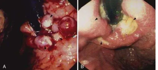 Gambar 2.5.  Gambaran endoskopi dari gastric varices dan esophageal variceal ligation-related ulcers (Shah, V.H., et al., 2010)  