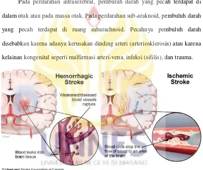 Gambar 2.1. Stroke Hemorrhagic dan Stroke Iskemik 