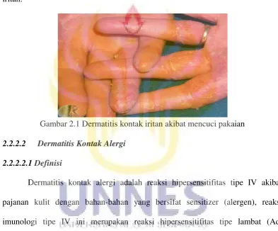 Gambar 2.1 Dermatitis kontak iritan akibat mencuci pakaian 