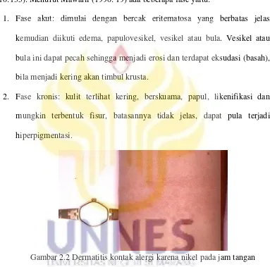 Gambar 2.2 Dermatitis kontak alergi karena nikel pada jam tangan 