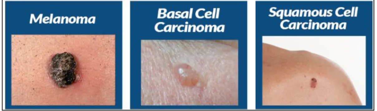 Gambar 2.1 Jenis kanker kulit (Dermatology, 2019) 