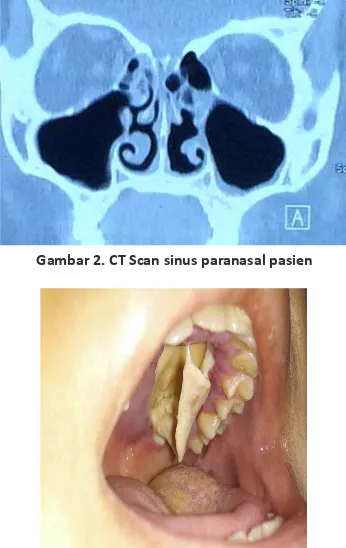Gambar 2. CT Scan sinus paranasal pasien 