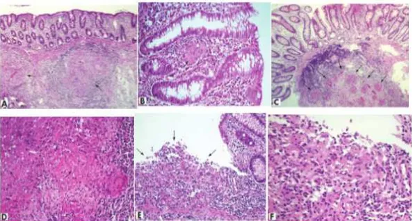 Gambar 2. Biopsi kolon pasien yang diwarnai dengan haematoxylin dan eosin (A) pasien dengan TB usus menunjukkan granuloma submukosa, pembesaran 4x