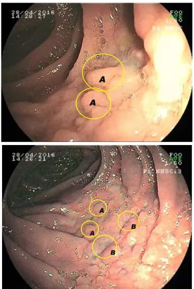 Gambar 2 Pada pemeriksaan enteroskopi, didapatkan pseudopolip mulipel (A) dengan ulserasi (B) pada intesinum proksimal