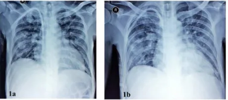 Gambar 1. Perbandian foto toraks awal perawatan (1a) serta evaluasi 5 hari setelah anibioik