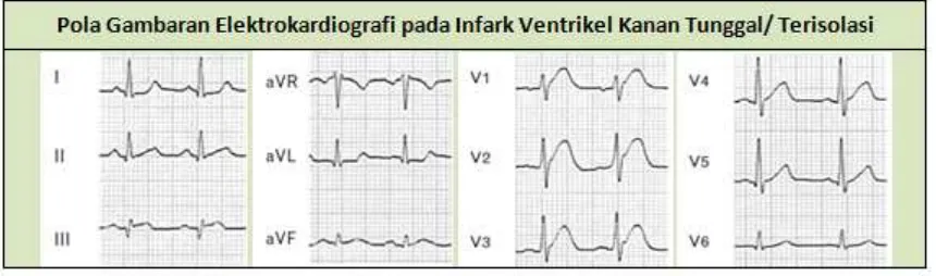 Gambar 7 Pola elektrokardiograi infark ventrikel kanan terisolasi14
