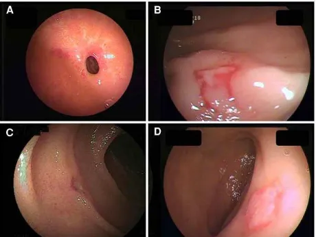 Gambar 5 Enteroskopi balon ganda pada enteropai OAINS. A: Striktur. B-D: Ulkus.13 