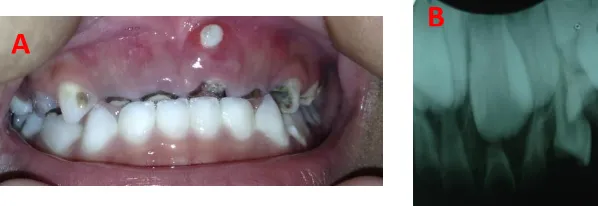 Gambar 1. A. Gambar awal gigi yang akan dilakukan perawatan pulpektomi; B. Pemeriksaan radiografi periapikal tanpa menunjukkan adanya kelainan periapikal 