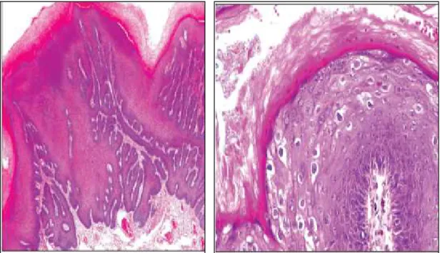 Gambar 1. Kondiloma Akuminatum. Akantosis prominen, hyperkeratosis, dan pemanjangan rete ridgesdan gambaran koilositosis
