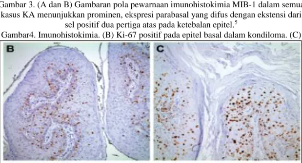 Gambar 3. (A dan B) Gambaran pola pewarnaan imunohistokimia MIB-1 dalam semua kasus KA menunjukkan prominen, ekspresi parabasal yang difus dengan ekstensi dari