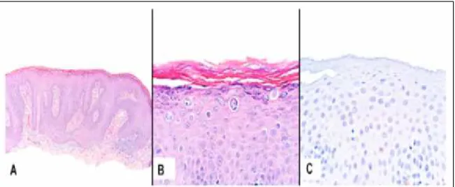 Gambar 5. A. Kondiloma akuminata. B. Pembesaran, nuclei hiperkromatik koilositosis. C