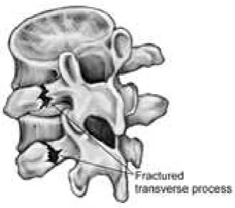 Gambar 2. Minor Fracture 