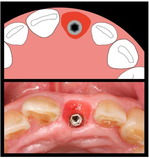 Figure 1.  Just after uncovering surgery, peri-implant mucosa shows a circular topography.