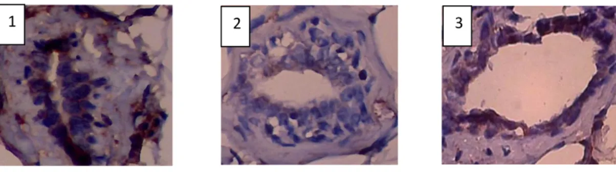 Gambar 2. Foto mikroskopis hasil perbesaran 400x uji imunohistokimia Bax (1) Kontrol normal (2) Kelompok  DMBA 20 mg/kg BB (3) DMBA 20 mg/kg BB + Doxorubicin 1,12 mg/kg BB + APB 100 mg/kg BB 