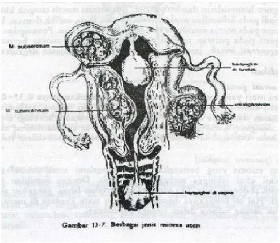 Gambar 2.1. Berbagai Jenis Mioma Uteri (Saifuddin, 2005) 