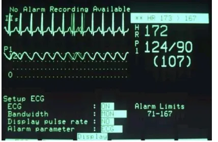 Gambar 1 sinyal Elektrokardiografi 