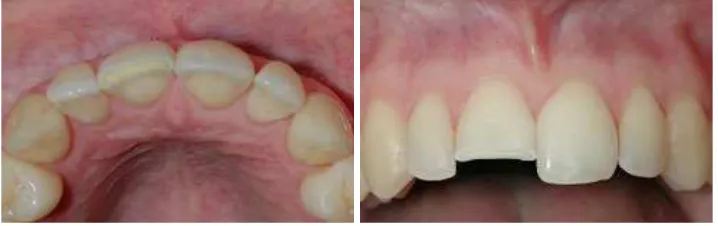 Figure 1. The permanent anterior teeth uncomplicated crown fracture without pulp exposure.8