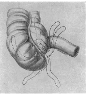 Gambar 2.1. Variasi letak apendiks vermiformis (Wakeley, 1933) 