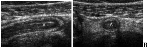 Gambar 2.4. Gambaran ultrasonografi apendisitis akut. (a) Axis memanjang dan 