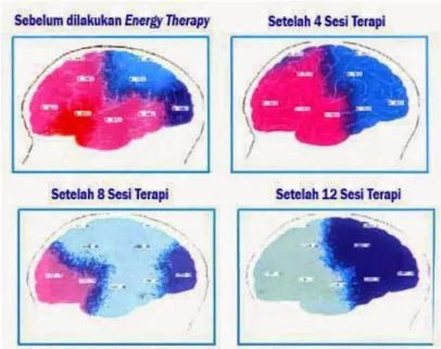 Gambar 2.5  Hasil Scan Otak setelah 12 sesi Energy Therapy pada penderita   gangguan kecemasan parah (Zainuddin, 2006) 